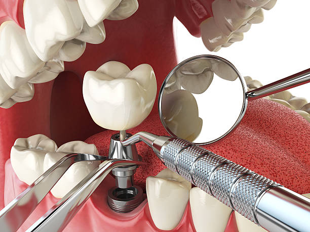 Best Knocked-Out Tooth (Avulsed Tooth) Treatment in Chester Center, CT